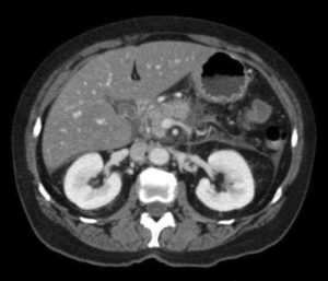 CT Scan of the Abdomen
