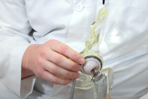 Hip Replacement Explained