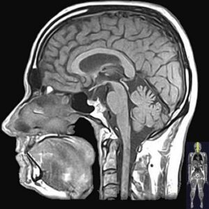 Example of an MRI scan of the head.