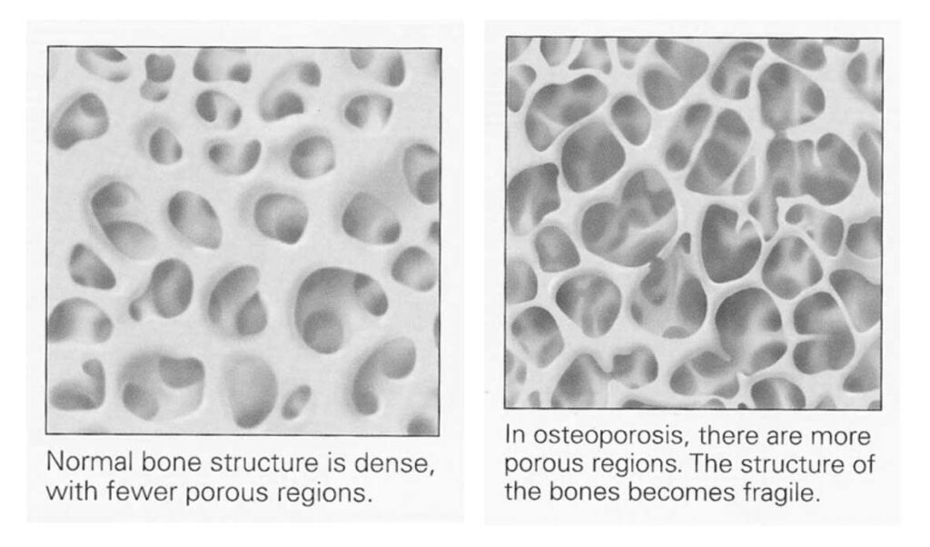 Normal bone structure is dense, with fewer porous regions. In osteoporosis, there are more porous regions. The structure of the bones becomes fragile. 